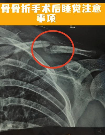 铃木唯人右肩骨折完成手术